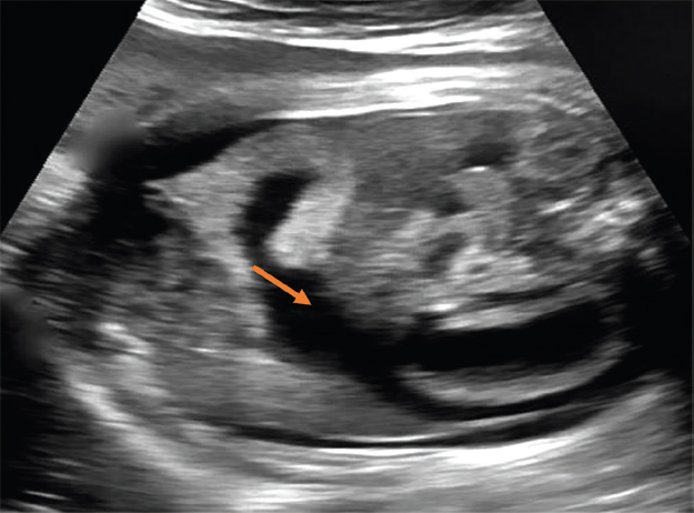 Dilated bowel loop.